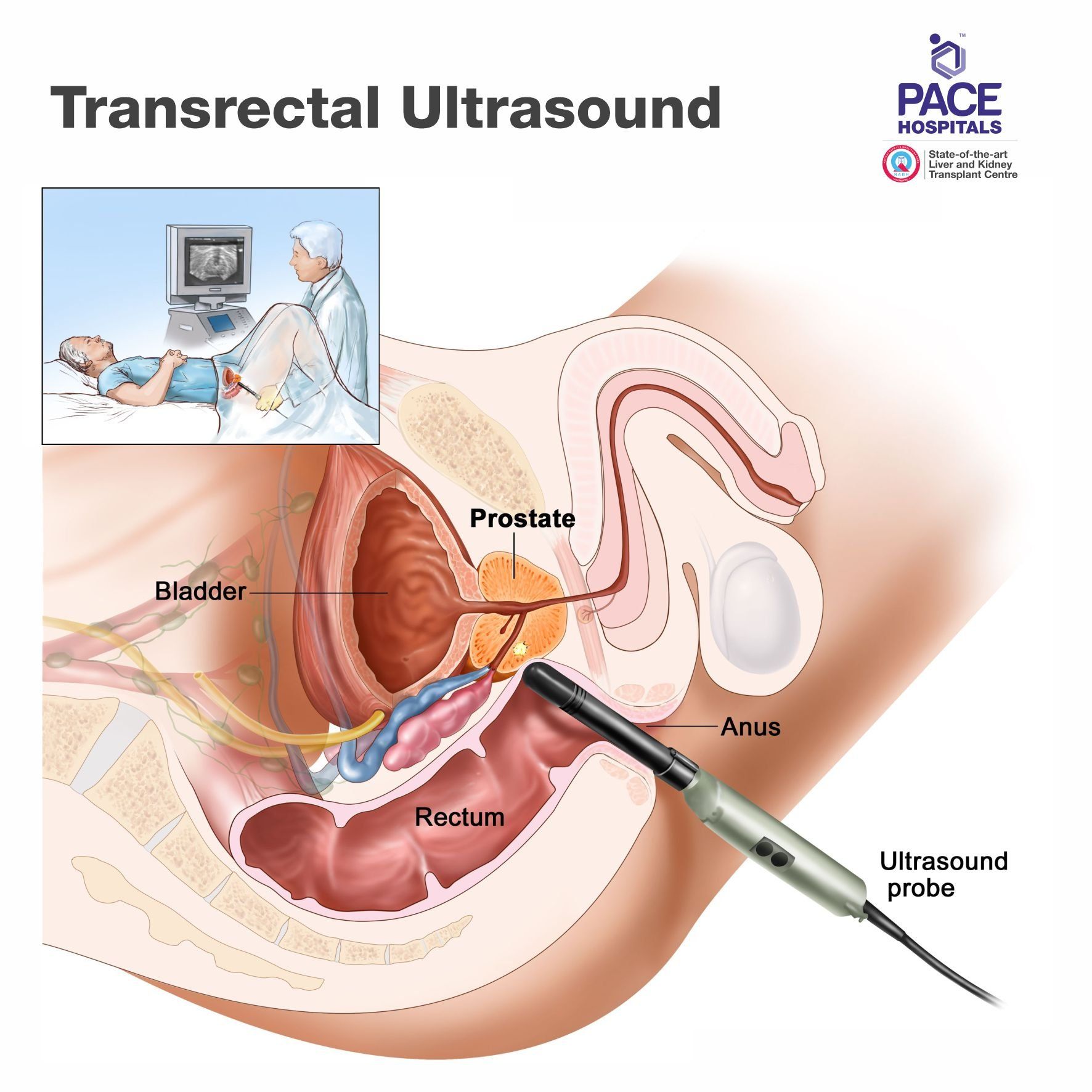 Transrectal ultrasound - Diagnosis of Prostate Cancer