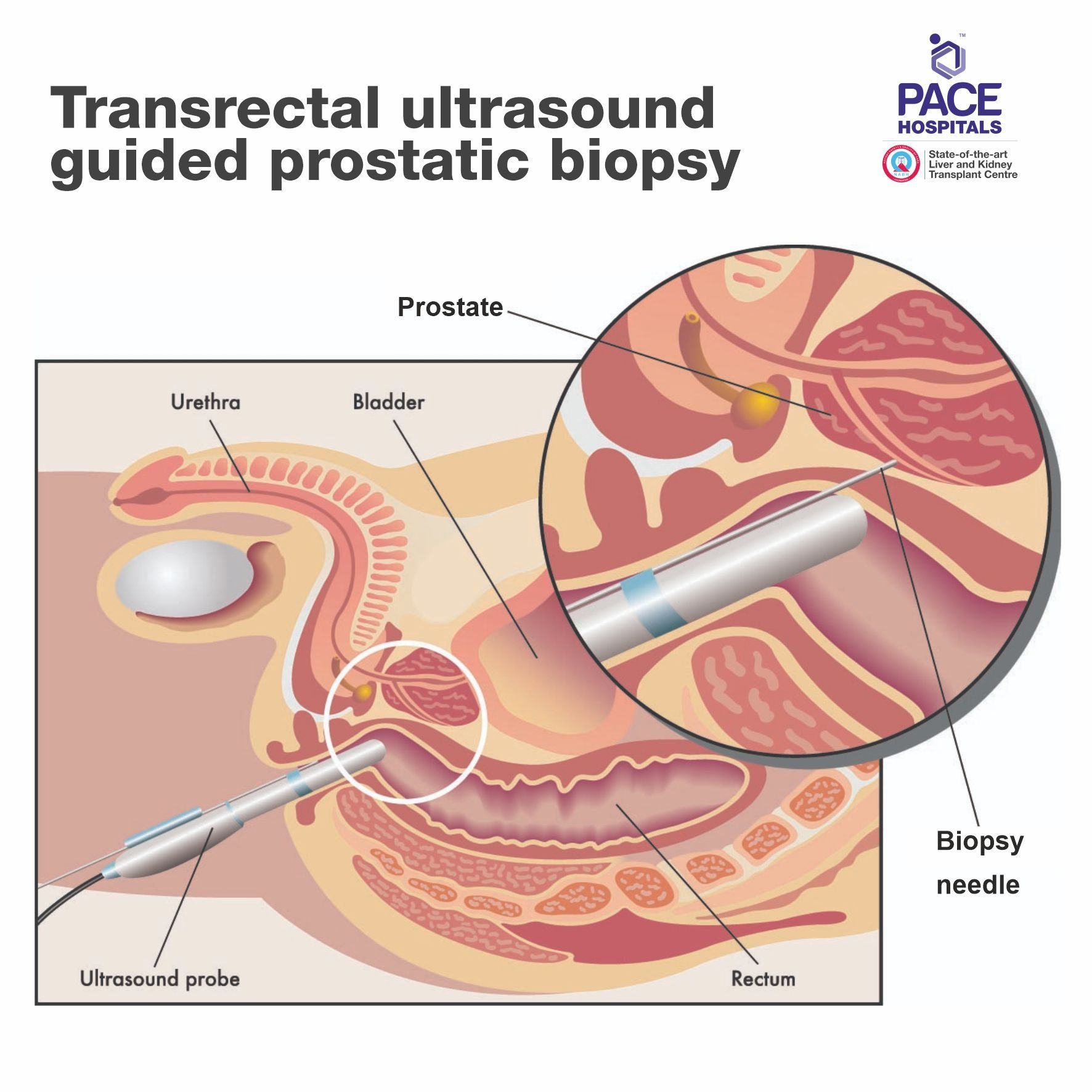 Transrectal ultrasound guided prostatic biopsy - Diagnosis of Prostate Cancer
