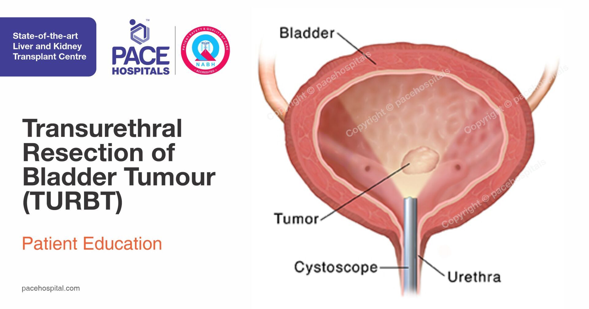 Transurethral Resection Of The Bladder