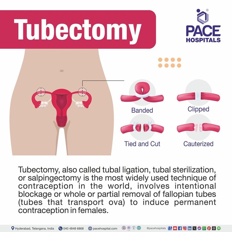 Tubectomy Surgery meaning | Tubectomy Procedure in Hyderabad, India | tubal ligation operation near me