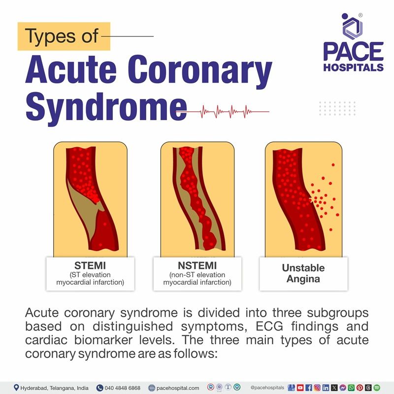 Acute coronary syndrome types acute coronary syndrome types | what are the three types of acute coronary syndrome | different types of acute coronary syndrome | Visual illustrating the different types of acute coronary syndrome