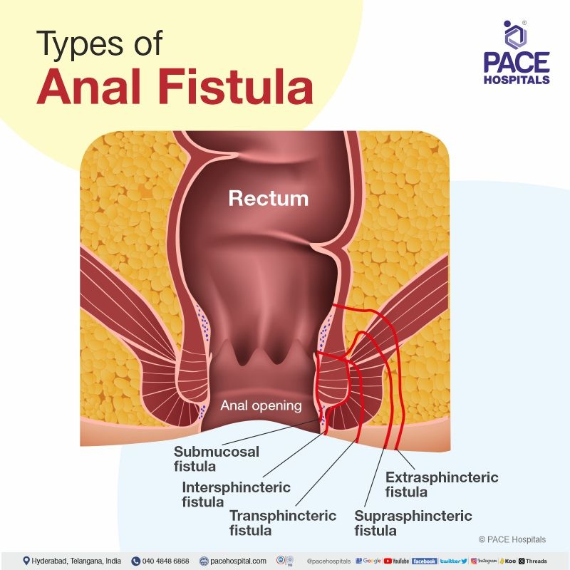 anal fistula types | about anal fistula causes and types | fistula in ano low and high types | what is anal fistula and its types | types of ano in fistula