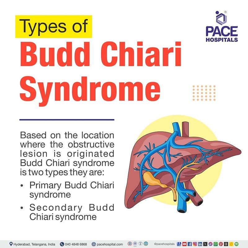Budd-Chiari syndrome types | types of Budd-chiari syndrome | Budd-chiari types | Visual demonstrating the types of Budd-Chiari Syndrome