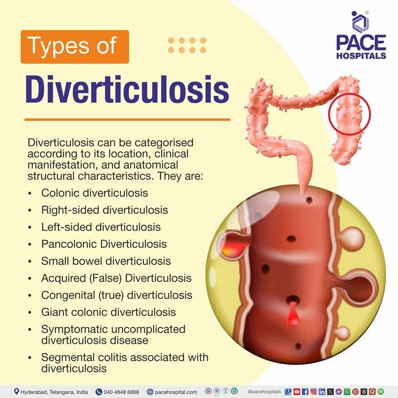 Types of Diverticulosis Types of Diverticulosis | Diverticulosis Types