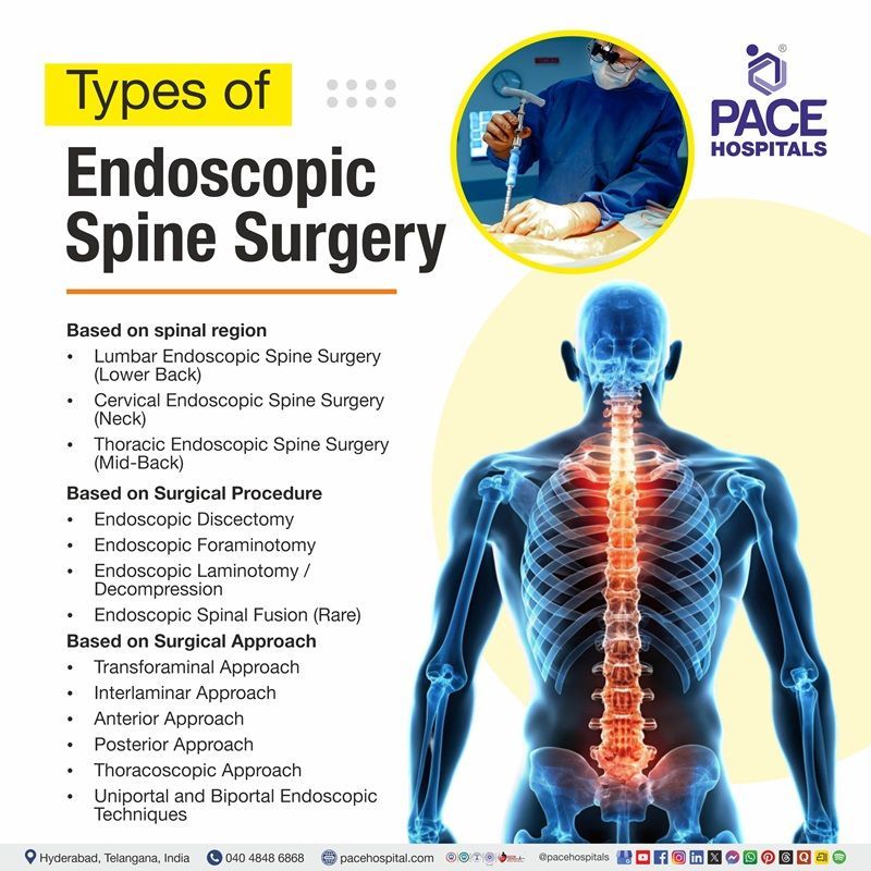 illustration of spine highlighting regions for endoscopic surgery types | 
