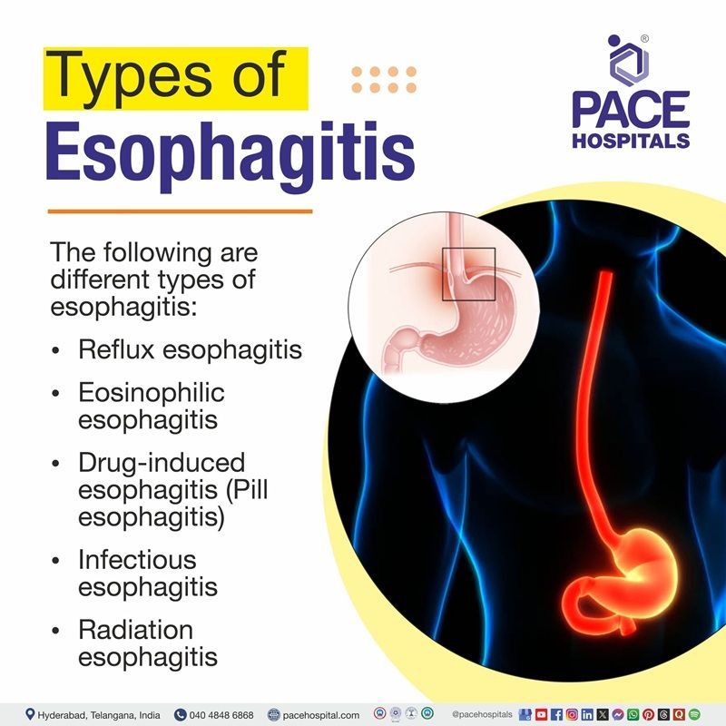 Types of Esophagitis Types of Esophagitis | Different Types of Esophagitis | Esophagitis Types