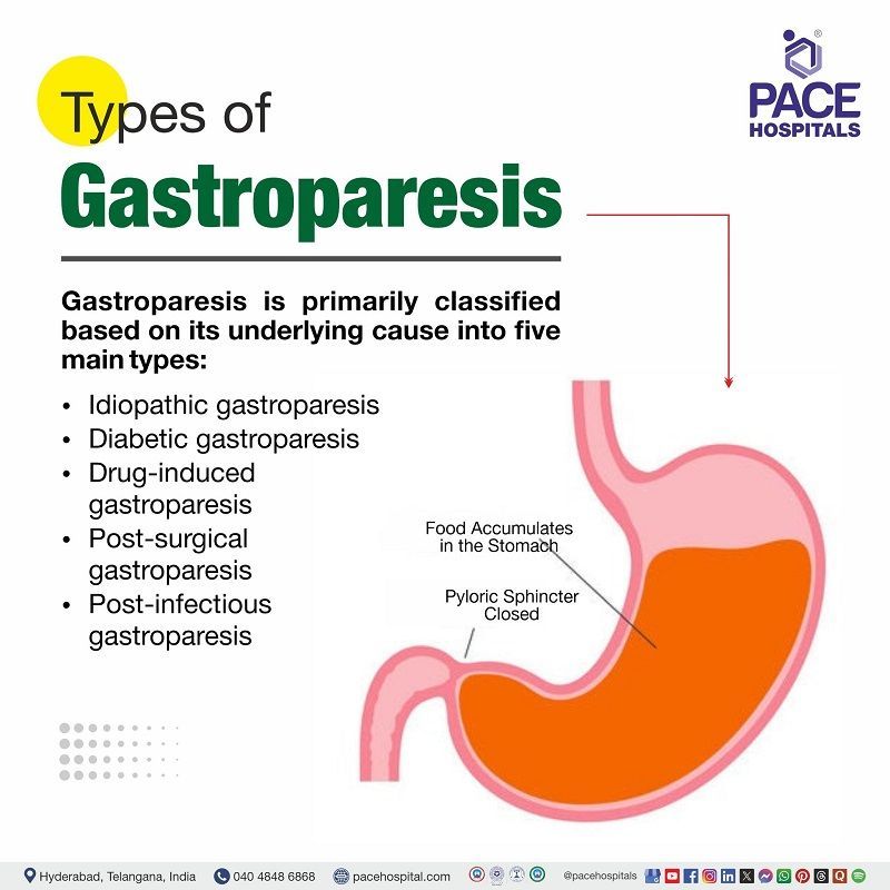 Types of Gastroparesis | Different Types of Gastroparesis | Gastroparesis Types