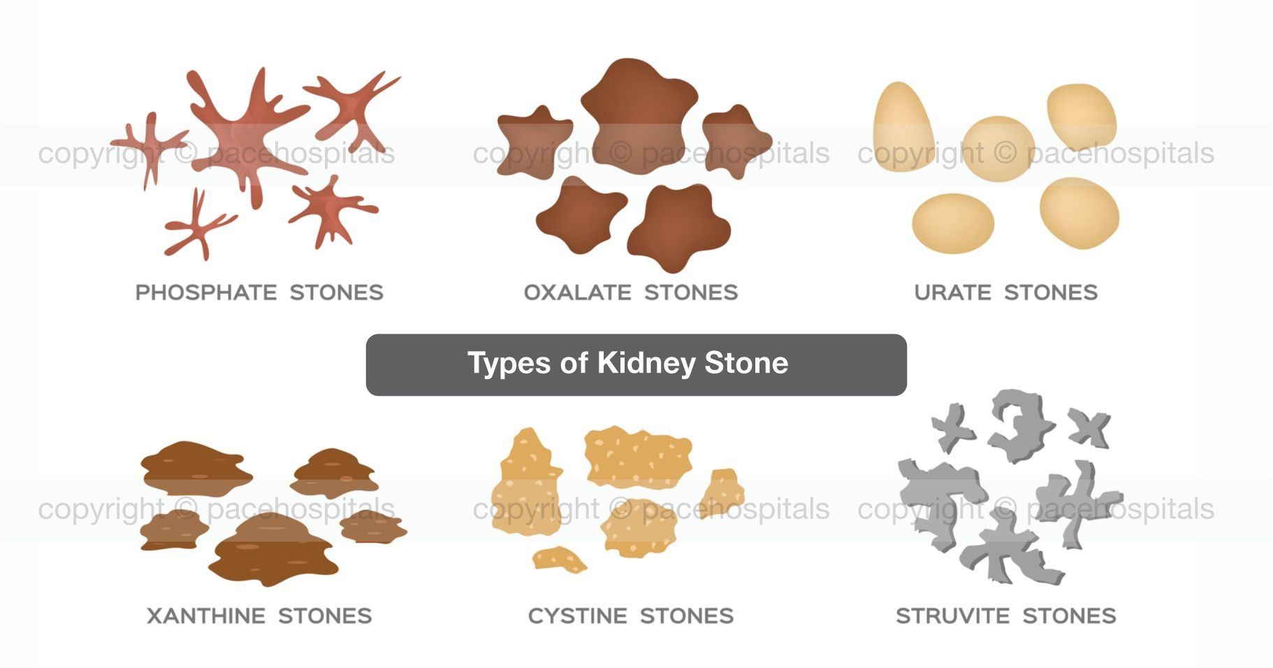 Types of Kidney Stone