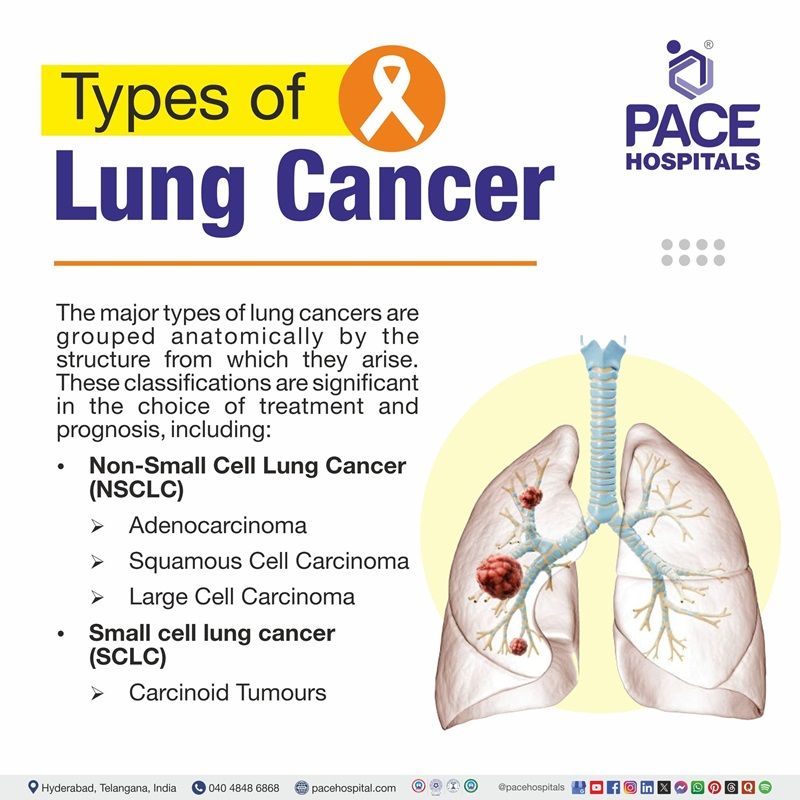 Types of lung cancer Types of Lung cancer | image showing the various lung cancer types