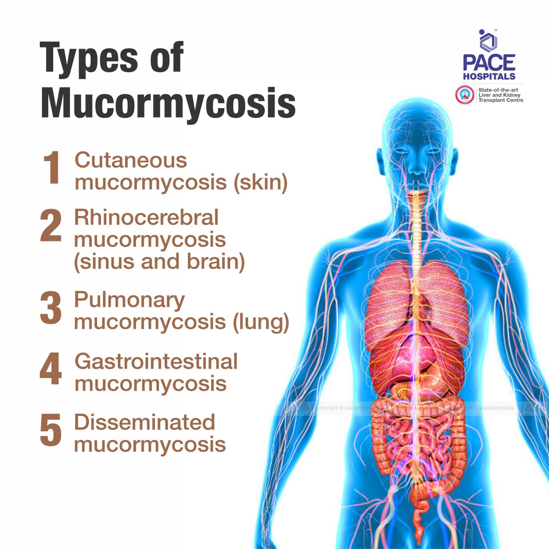 Types of Mucormycosis - Pulmonary mucormycosis (lung), Rhinocerebral mucormycosis (sinus and brain), Cutaneous mucormycosis (skin), Gastrointestinal mucormycosis, Disseminated mucormycosis