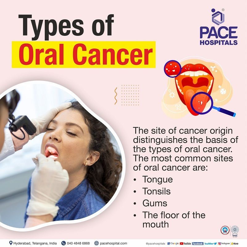 different types of oral cancer | types of oral and oropharyngeal cancer | types of oral cavity cancer | what type of cancer is oral cancer
