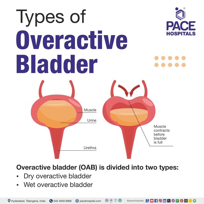Overactive bladder types Types of overactive bladder | Over active bladder types | What are the different types of Overactive bladder | Visual depicting the different types of Overactive bladder