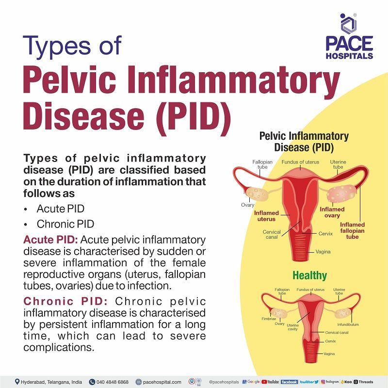 types of pelvic inflammatory disease | pelvic inflammatory disease PID types