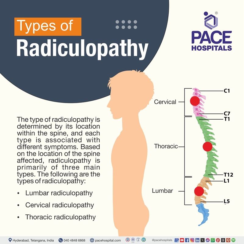 Types of Radiculopathy Types of Radiculopathy | Radiculopathy types