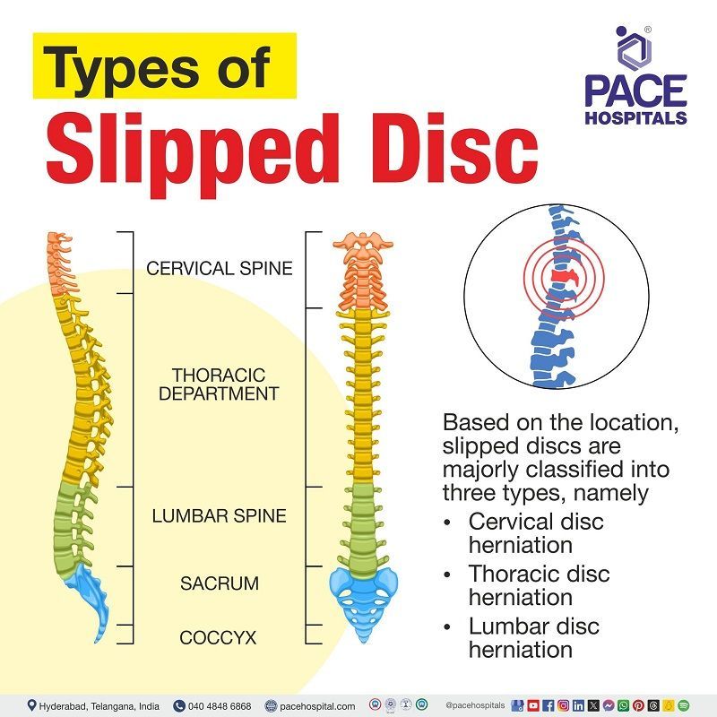 Types of slip disc | types of disc herniation | types of lumbar disc herniation | Visual depicting the different types of Slipped Disc