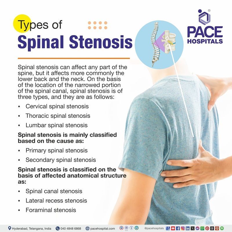 Types of Spinal Stenosis Types of Spinal Stenosis | visual depicting spinal stenosis types