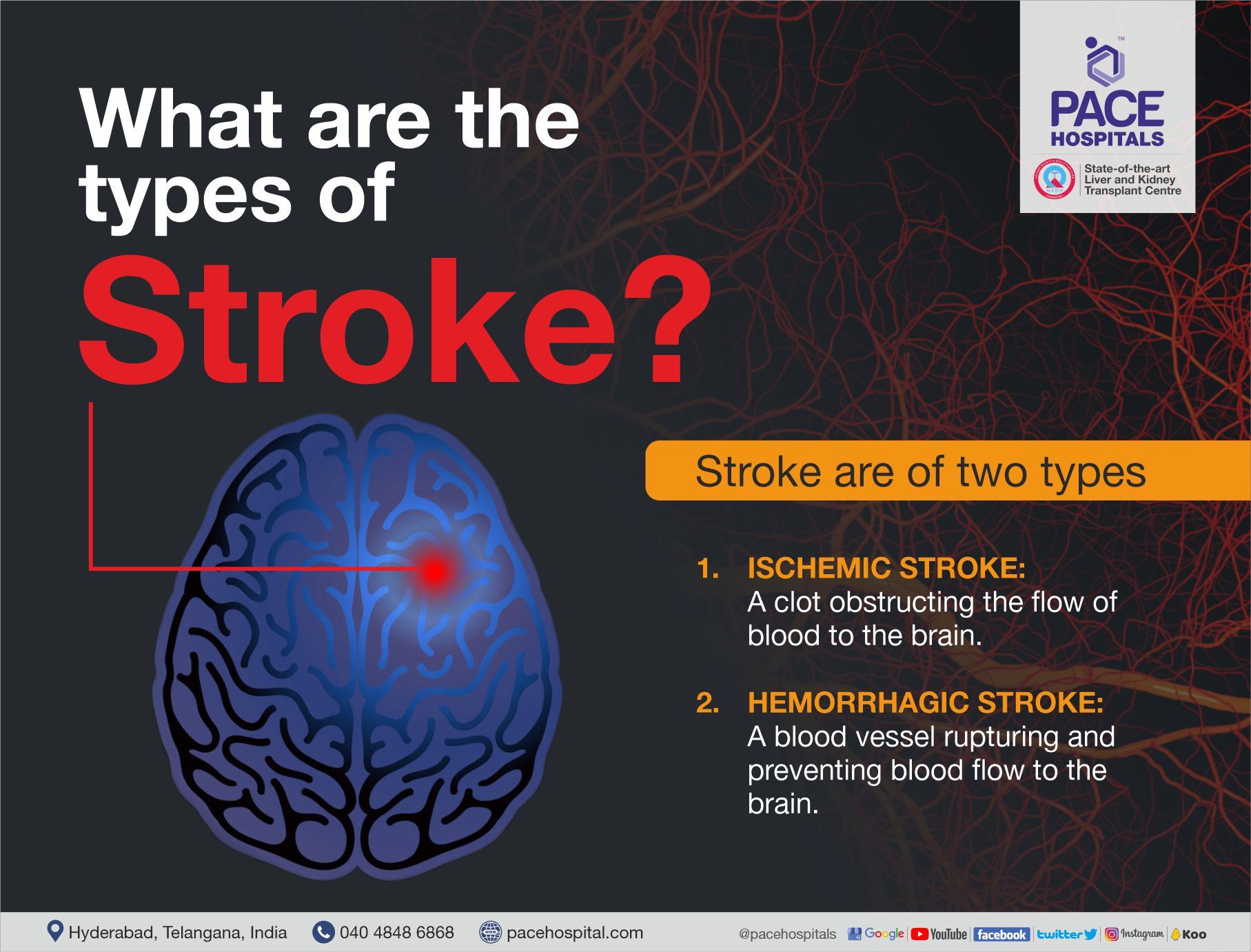 Types of Stroke | Stroke and diet: An Indian Perspective