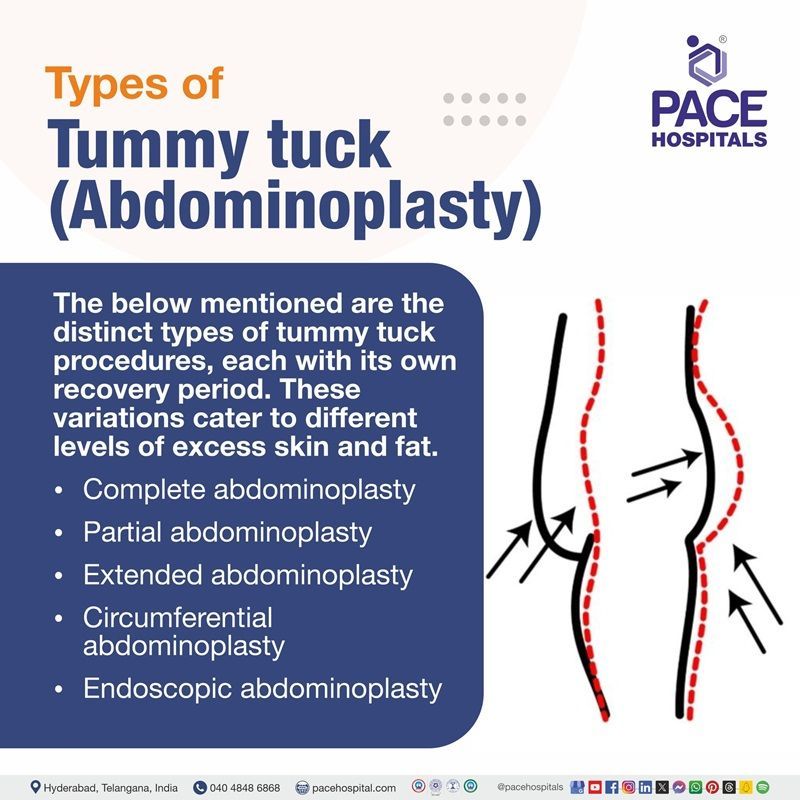 types abdominoplasty | different types of tummy tuck procedures | tummy tuck incision types | types of tummy tucks | abdominoplasty surgery types | Visual narrating the different types of tummy tucks