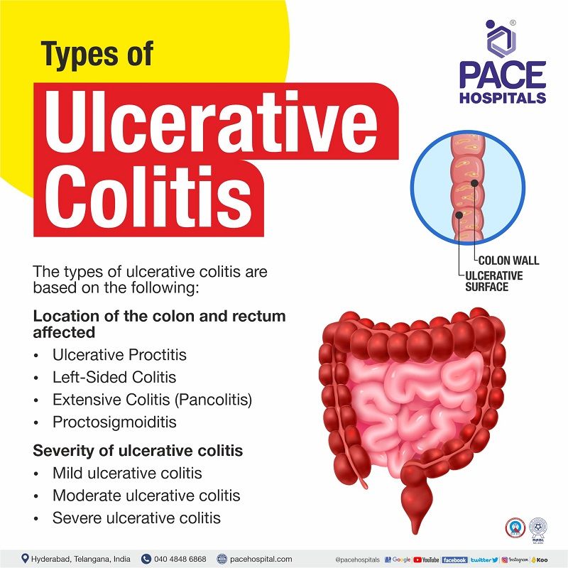different types of ulcerative colitis | ulcerative colitis types