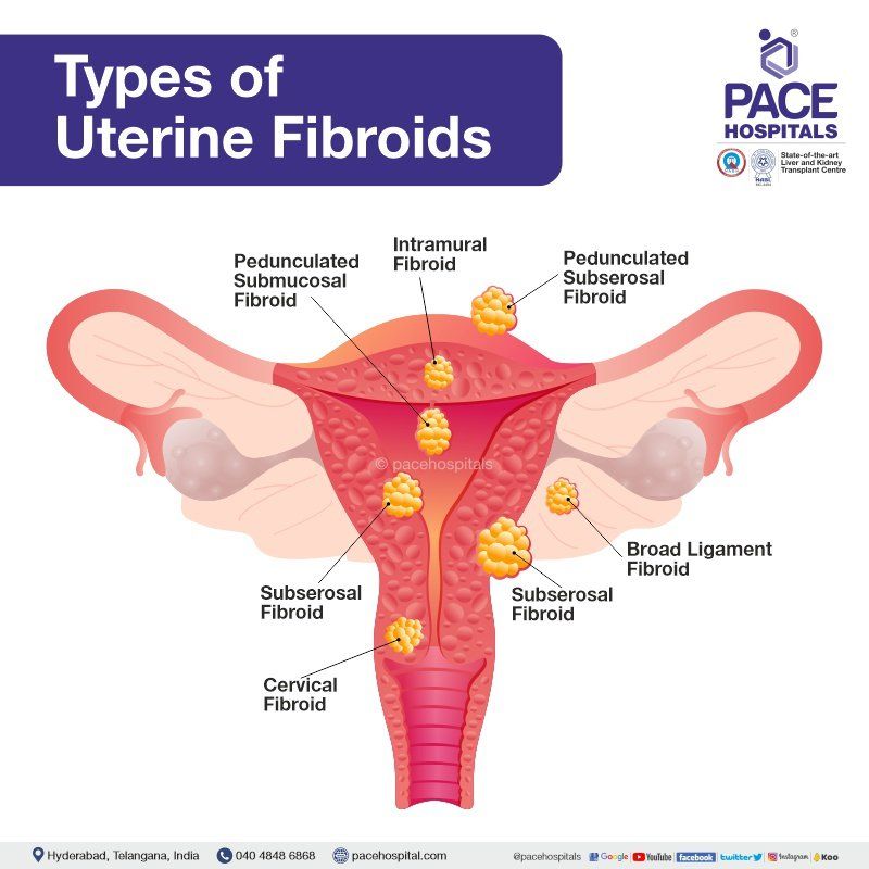 Types of Fibroids | Types of Uterine Fibroids