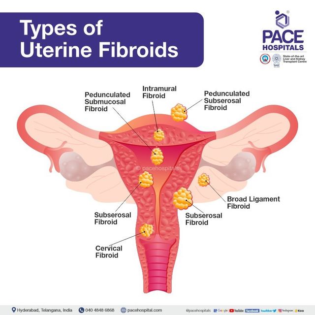 uterine fibroids images