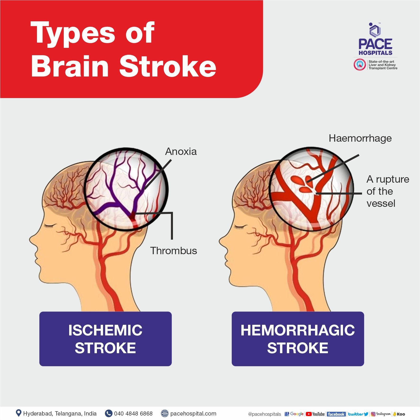 Types of Brain Stroke - Ischemic stroke and Haemorrhagic stroke