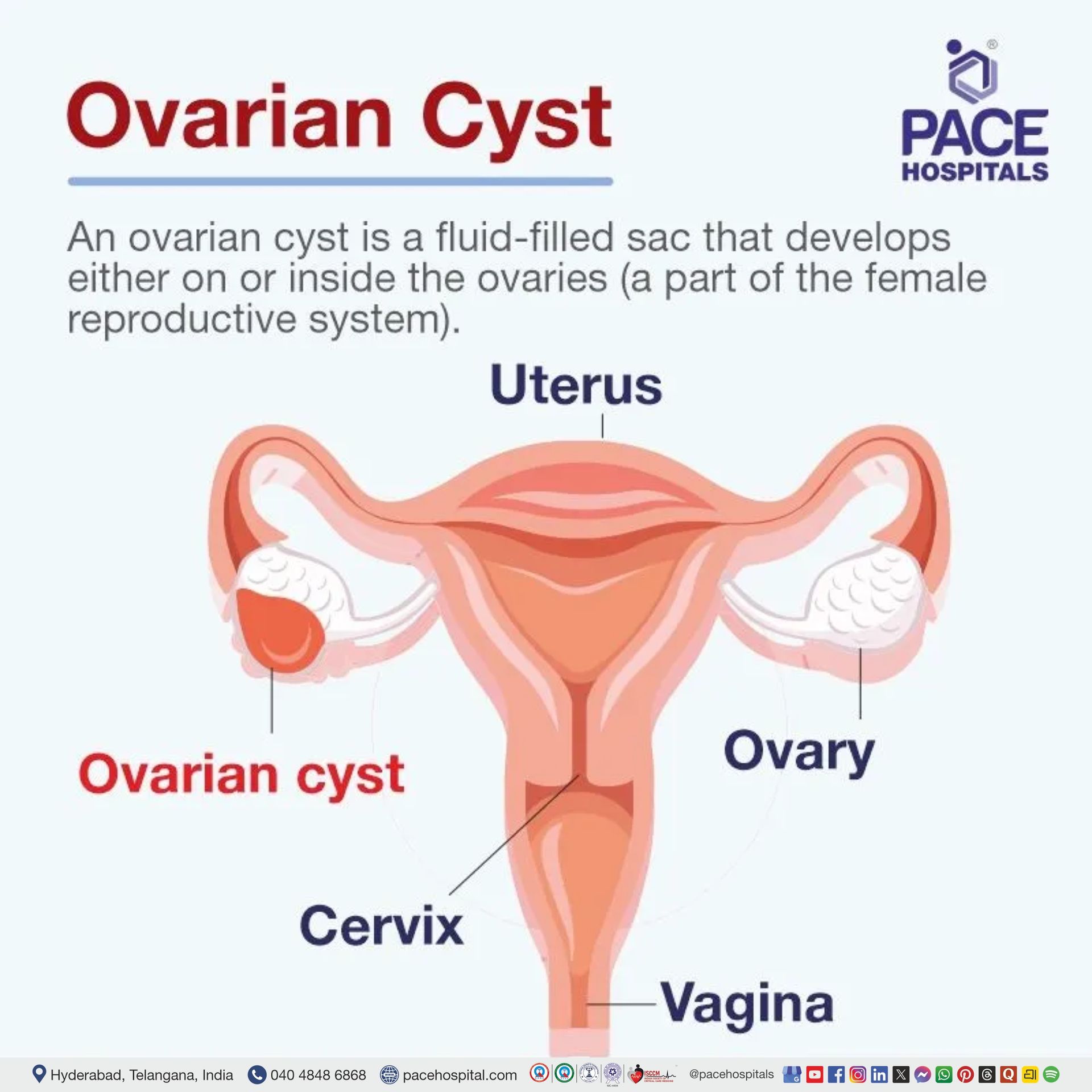 what is the ovarian cyst ovarian cyst meaning | ovarian cyst meaning in english | ovarian cyst means in medical | what is the meaning of ovarian cyst | ovarian cyst definition