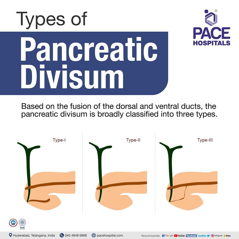 pancreas divisum types | types of pancreas divisum | pancreatic divisum types