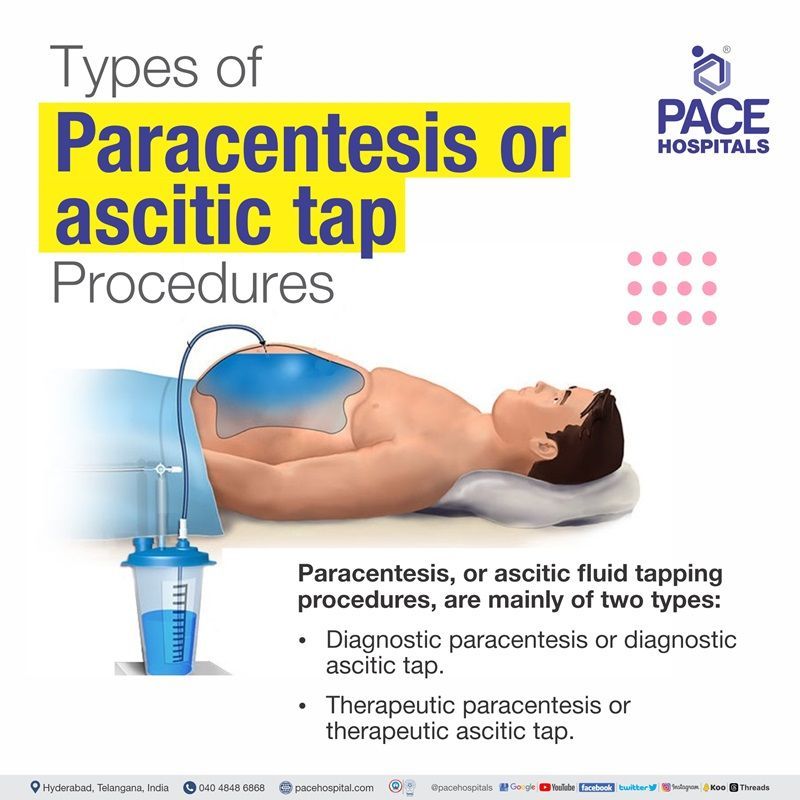 abdominal paracentesis types | ascites tapping types | types of paracentesis procedure ascitic fluid tapping | ascitic fluid tapping procedure types