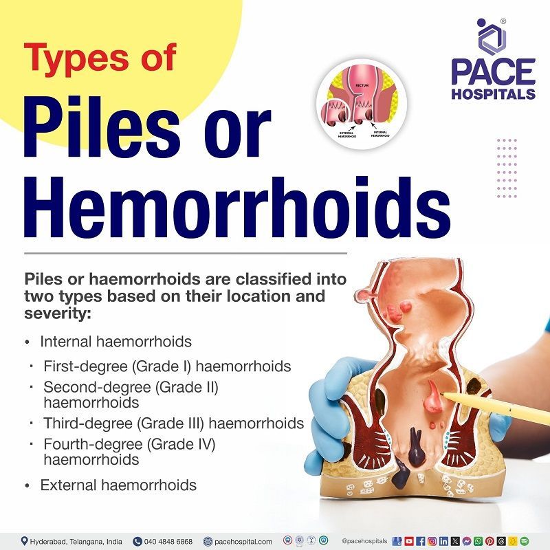 Types of Piles (Hemorrhoids) Types of Piles (Hemorrhoids) | how many types of piles | different types of piles |