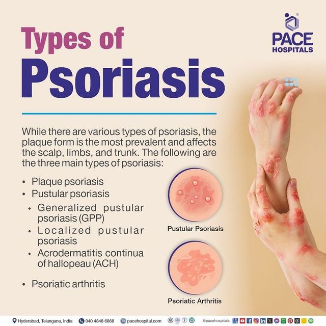 Pustular Psoriasis Causes Psoriasis Symptoms NHS