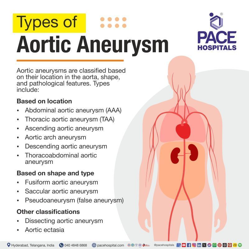 Types of Aortic Aneurysm | Most common type of aortic aneurysm | Aortic aneurysm types