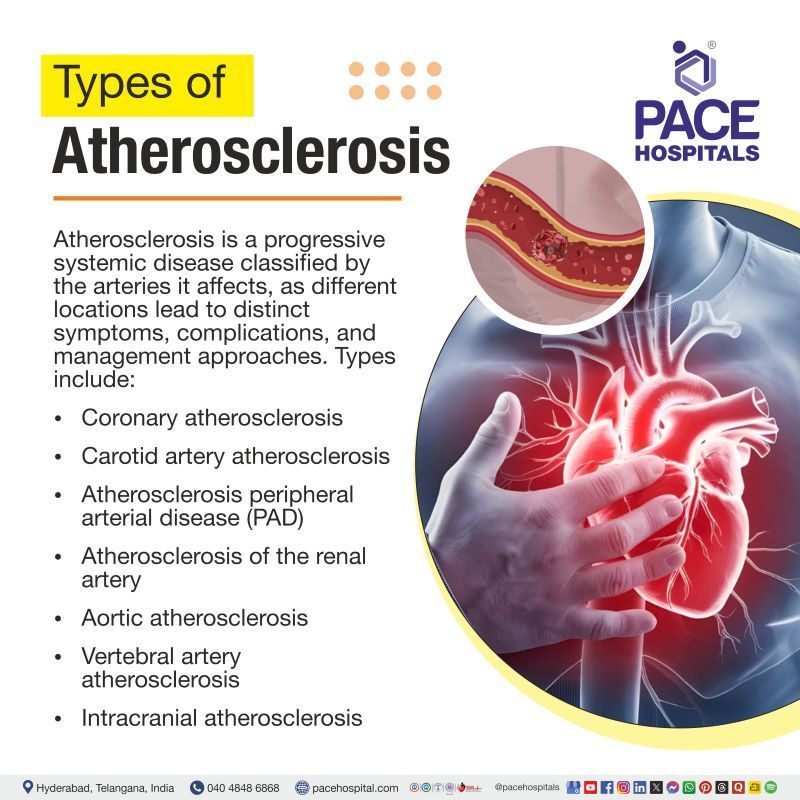 Types of Atherosclerosis | Different types of atherosclerosis | Atherosclerosis