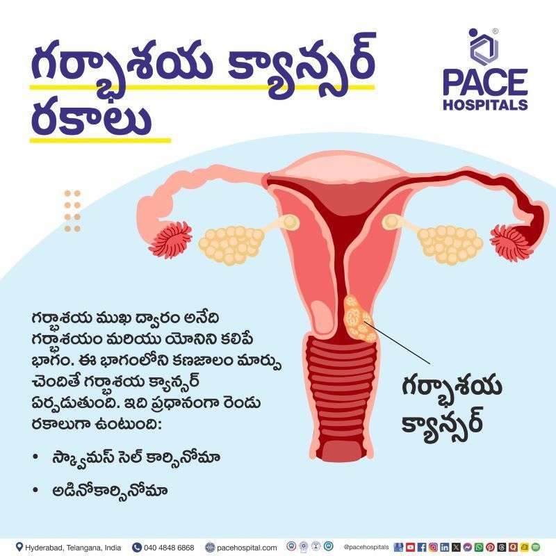 గర్భాశయ క్యాన్సర్ రకాలు | Types of Cervical Cancer in Telugu Types of Cervical Cancer in Telugu | గర్భాశయ క్యాన్సర్ రకాలు | Cervical Cancer Types in Telugu