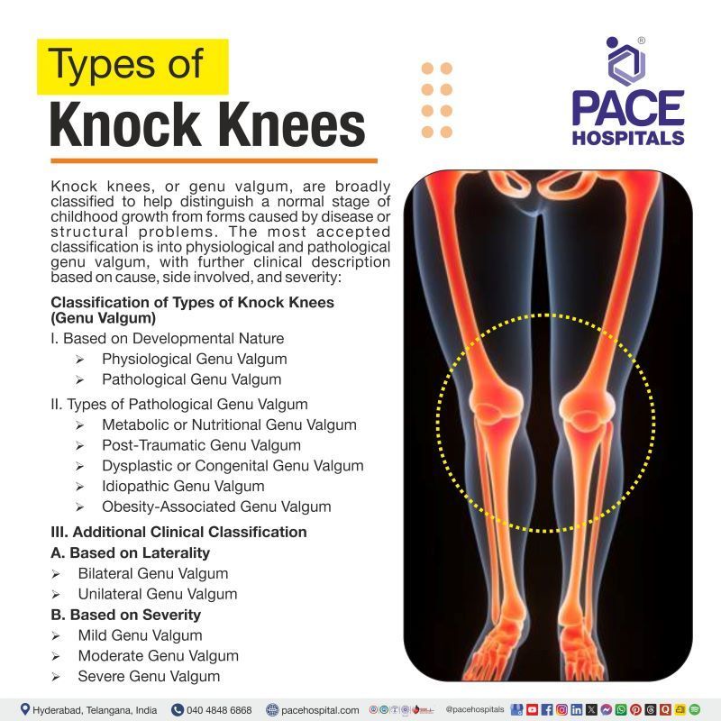 Types of Knock Knees | Knock knees types | All types of knock knees | Genu Valgum Types