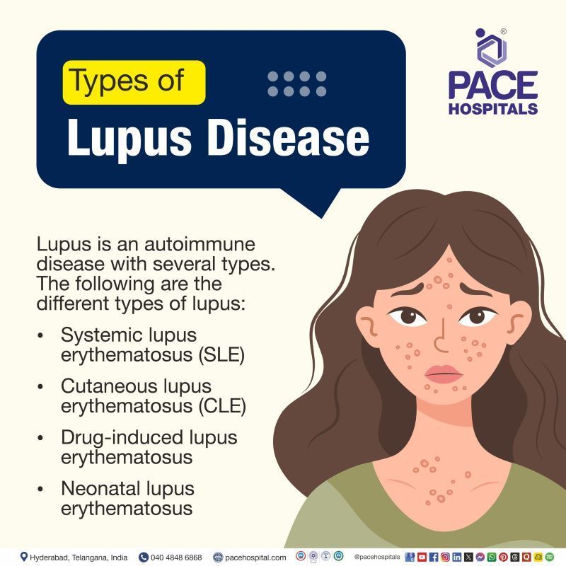 Types of Lupus | What are the 4 types of lupus | Lupus types