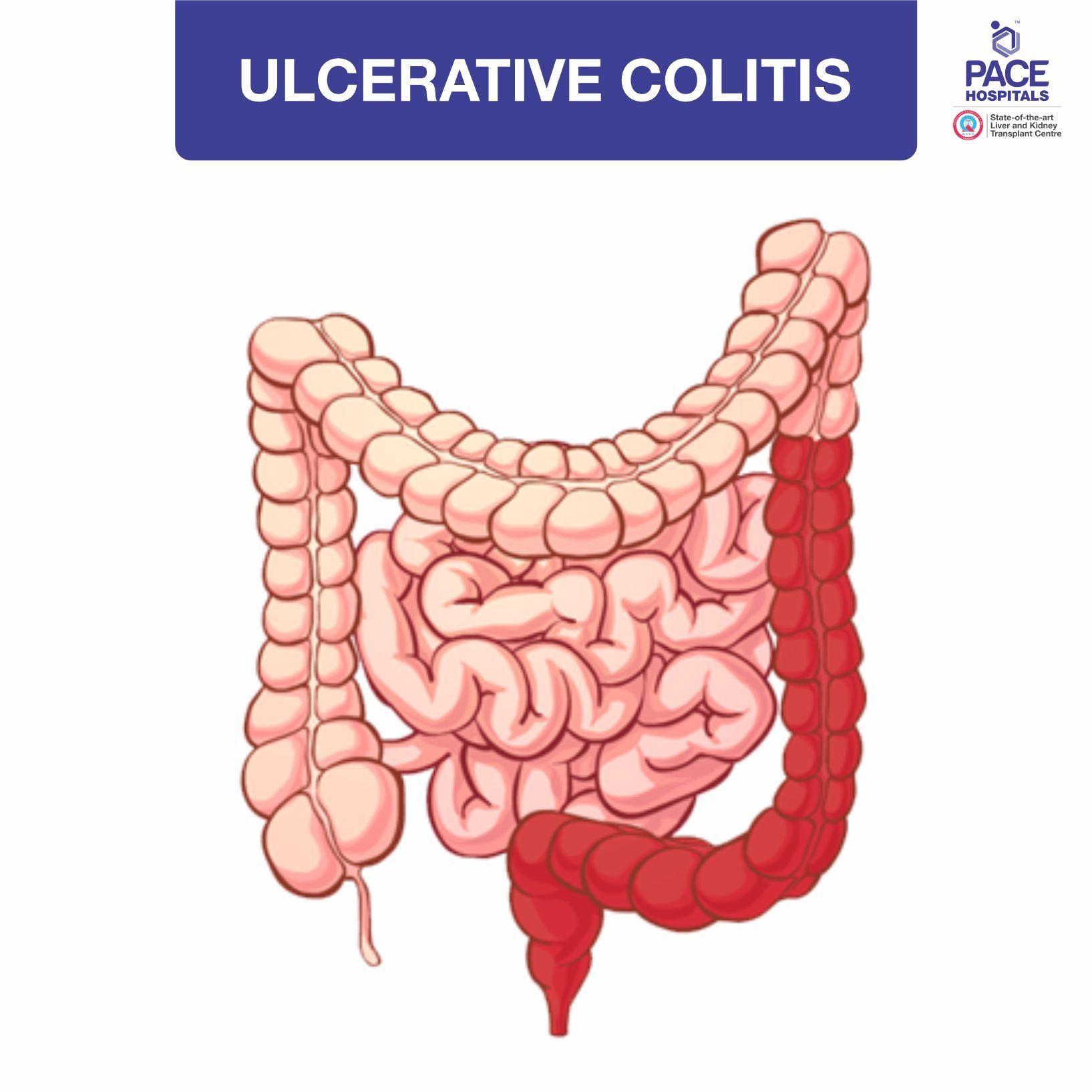 ULCERATIVE COLITIS - Type of Inflammatory bowel disease (IBD)