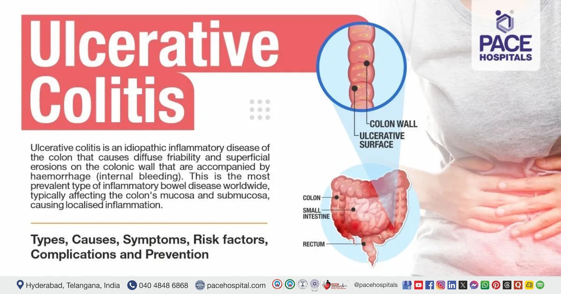 Ulcerative Colitis – Symptoms, Causes, Types, Complications, Risk Factors & Prevention