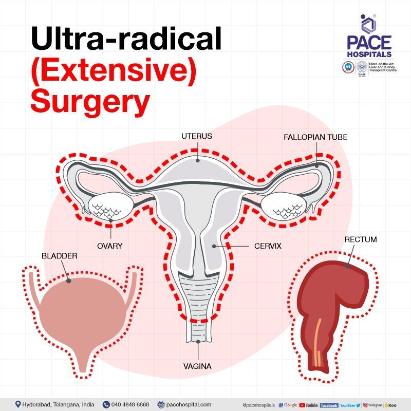 Ultra radical hysterectomy in Hyderabad | Ultra radical hysterectomy in India | Ultra radical hysterectomy