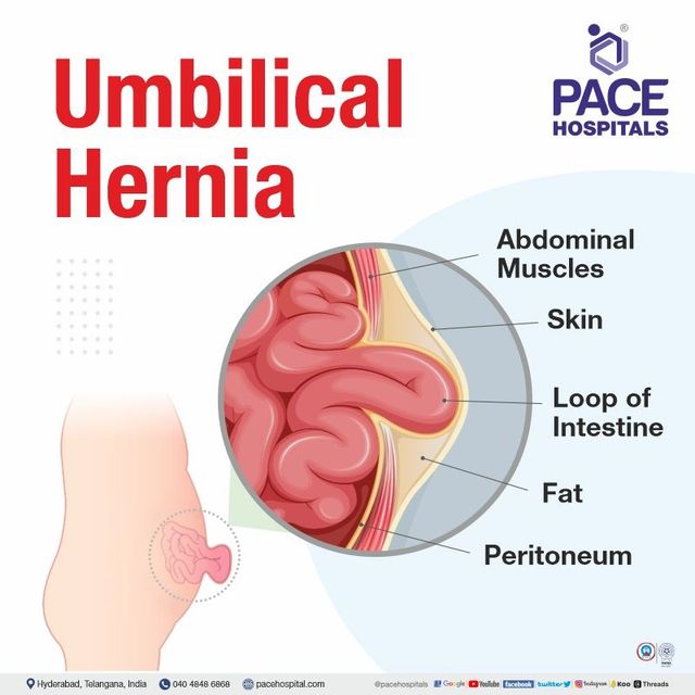 Umbilical hernia in adults and other Related Problems