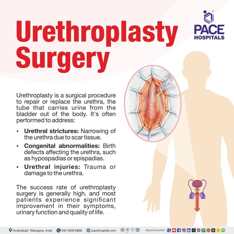 urethroplasty surgery meaning | urethroplasty surgery cost in India | buccal mucosal graft urethroplasty in Hyderabad | urethroplasty surgery cost in Hyderabad 