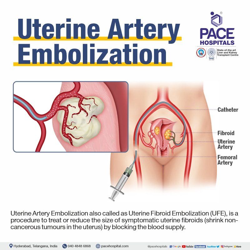 Uterine fibroid embolization hospital in Hyderabad | uterine artery embolization surgery | uterine fibroid embolization procedure | UFE Surgery