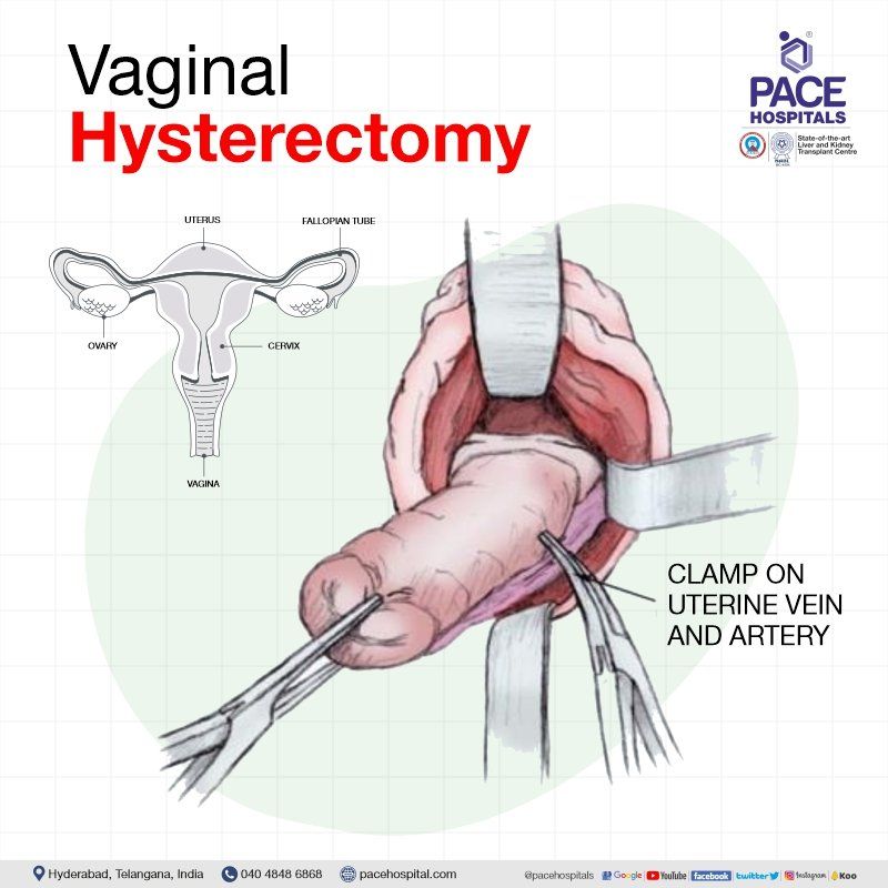 Vaginal hysterectomy in Hyderabad | Vaginal hysterectomy in India | Vaginal hysterectomy procedure | Vaginal hysterectomy surgery | vaginal hysterectomy cost