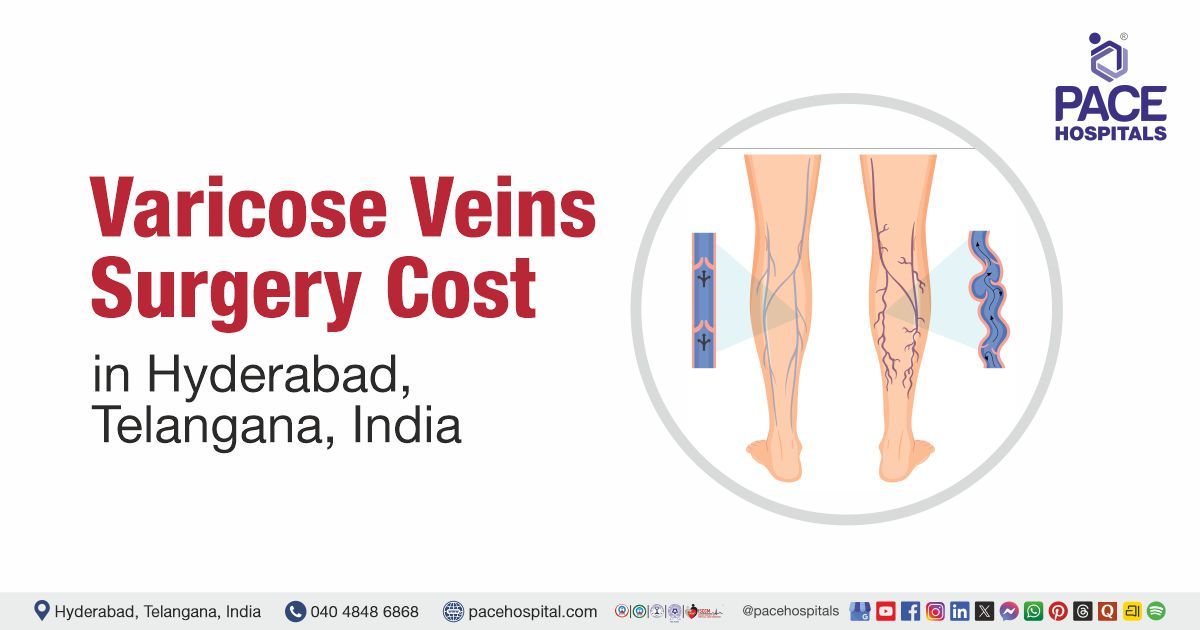Varicose Veins Surgery Cost in Hyderabad at PACE Hospitals. Cost of Varicose Veins Surgery in Hydera