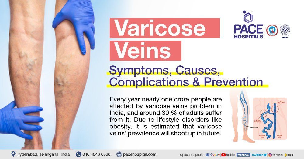 varicose veins hospital recommendation severe leg pain