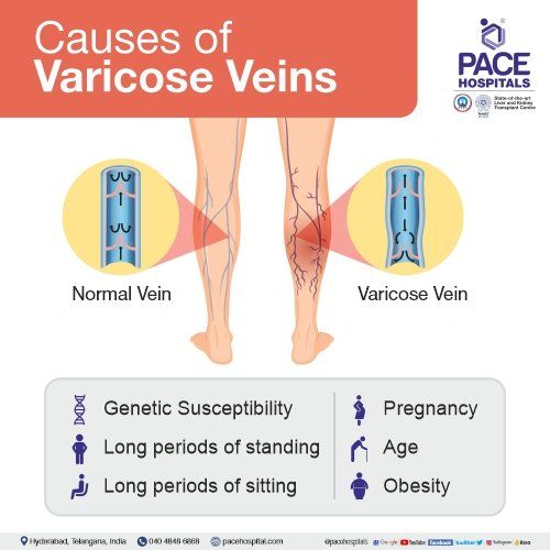 Varicose veins - Venous diseases - Compression - Indications