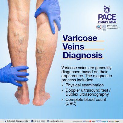 varicose veins diagnosis in hyderabad | doppler ultrasound | duplex ultrasonography
