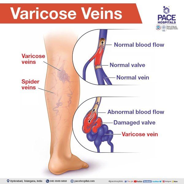Varicose veins on a female senior legs. The structure of normal