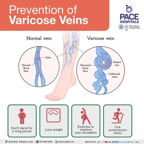 7 Ways to prevent Varicose Veins - Varicose Veins Prevention.