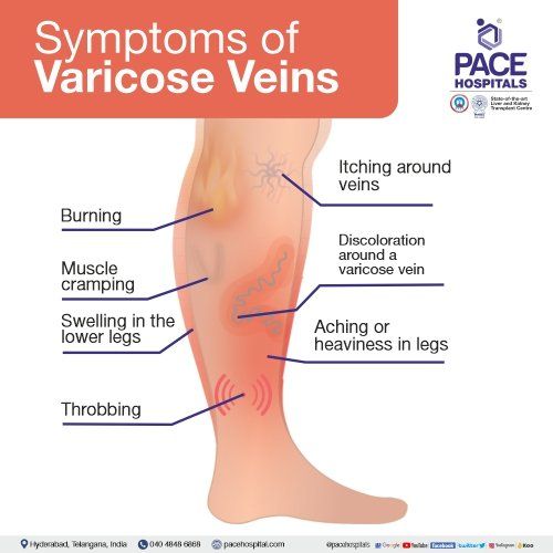 Varicose veins on a female senior legs. The stages of varicose